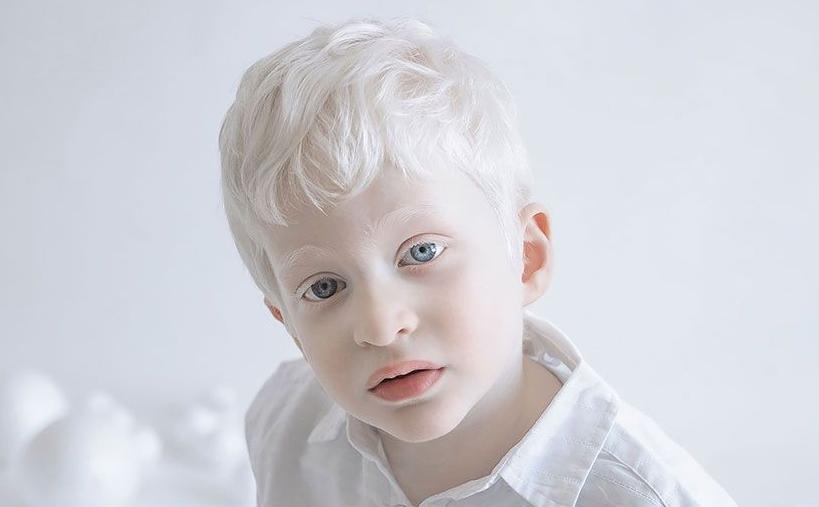 albinism. an albino childh looking at the camera